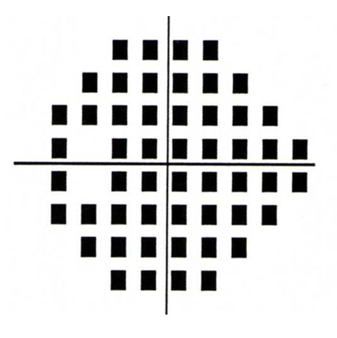 test results showing End stage glaucoma with dense superior and inferior visual field defects